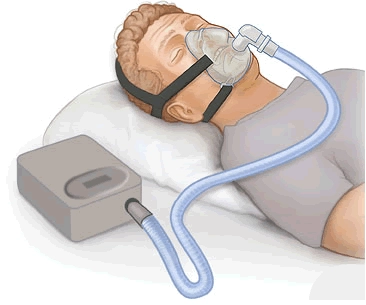جایگاه تصویر دستگاه CPAP و ماسک برای درمان آپنه خواب